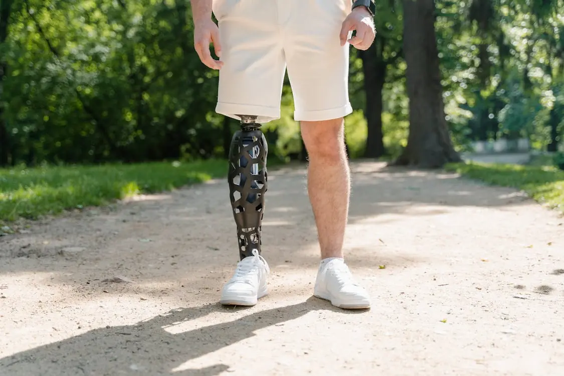 Amputation: Reasons and Considerations