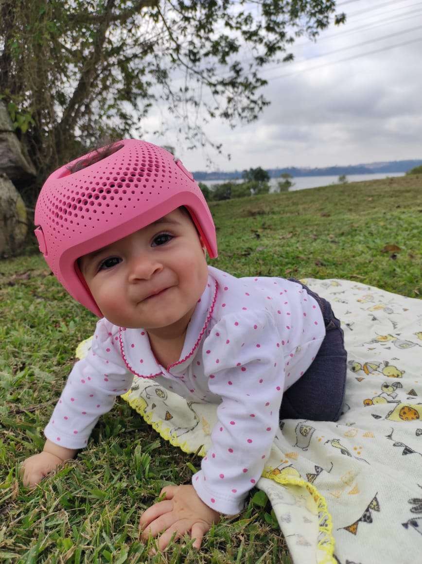 Cranial Helmets for Babies: What Parents Need to Know